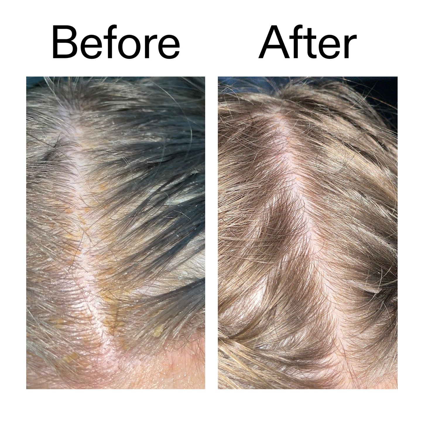 salicylic-acid-exfoliating-scalp-treatment-e5 Salicylic_Acid_Exfoliating_Scalp_Treatment_Before_After_2000x2000_e572a30f-057c-4a48-823b-1c09dc97f8d0.jpg