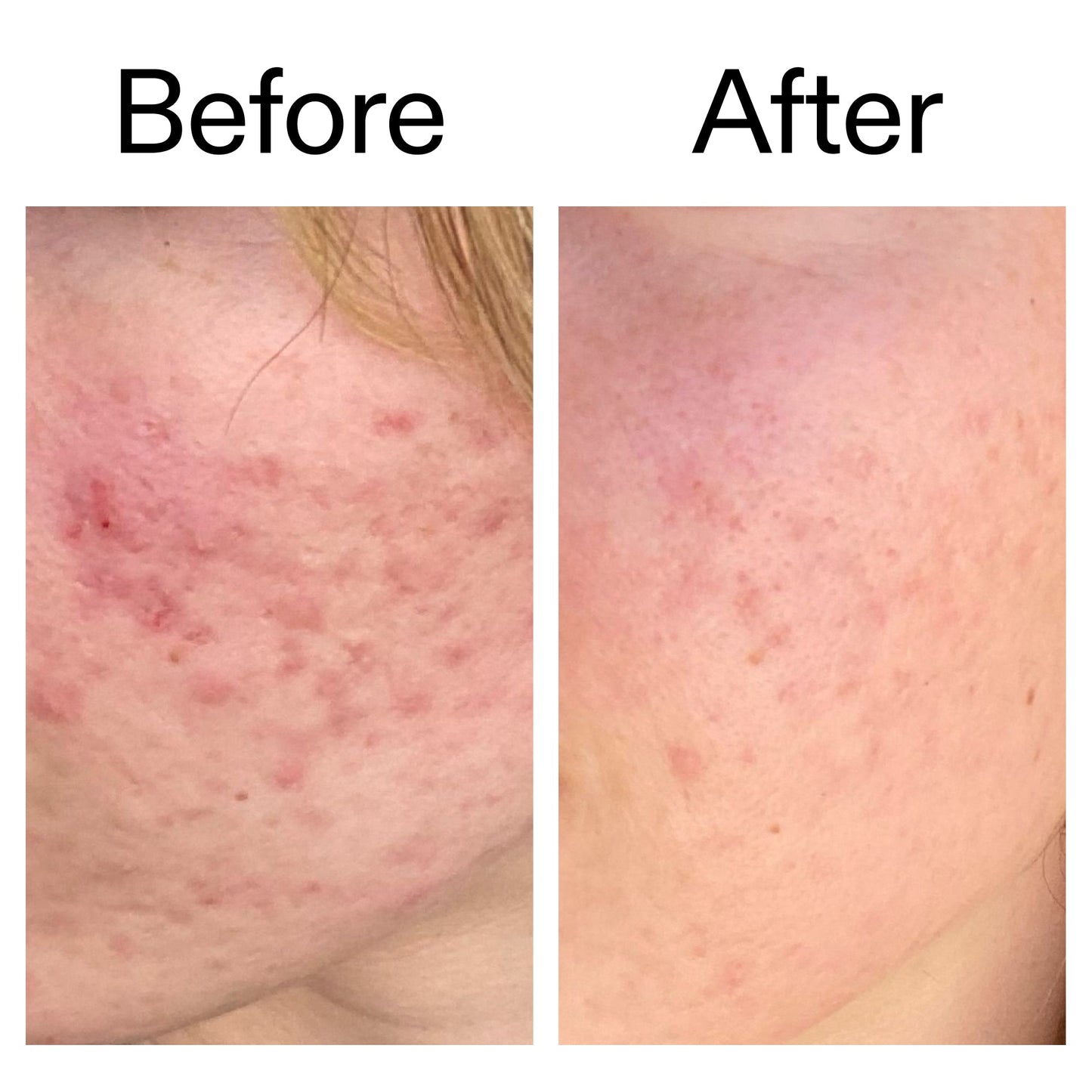 10-azelaic-acid-serum-for-redness-relief-t9 Azealic_Acid_Serum_B_A_Ppage_2000_x_2000.jpg