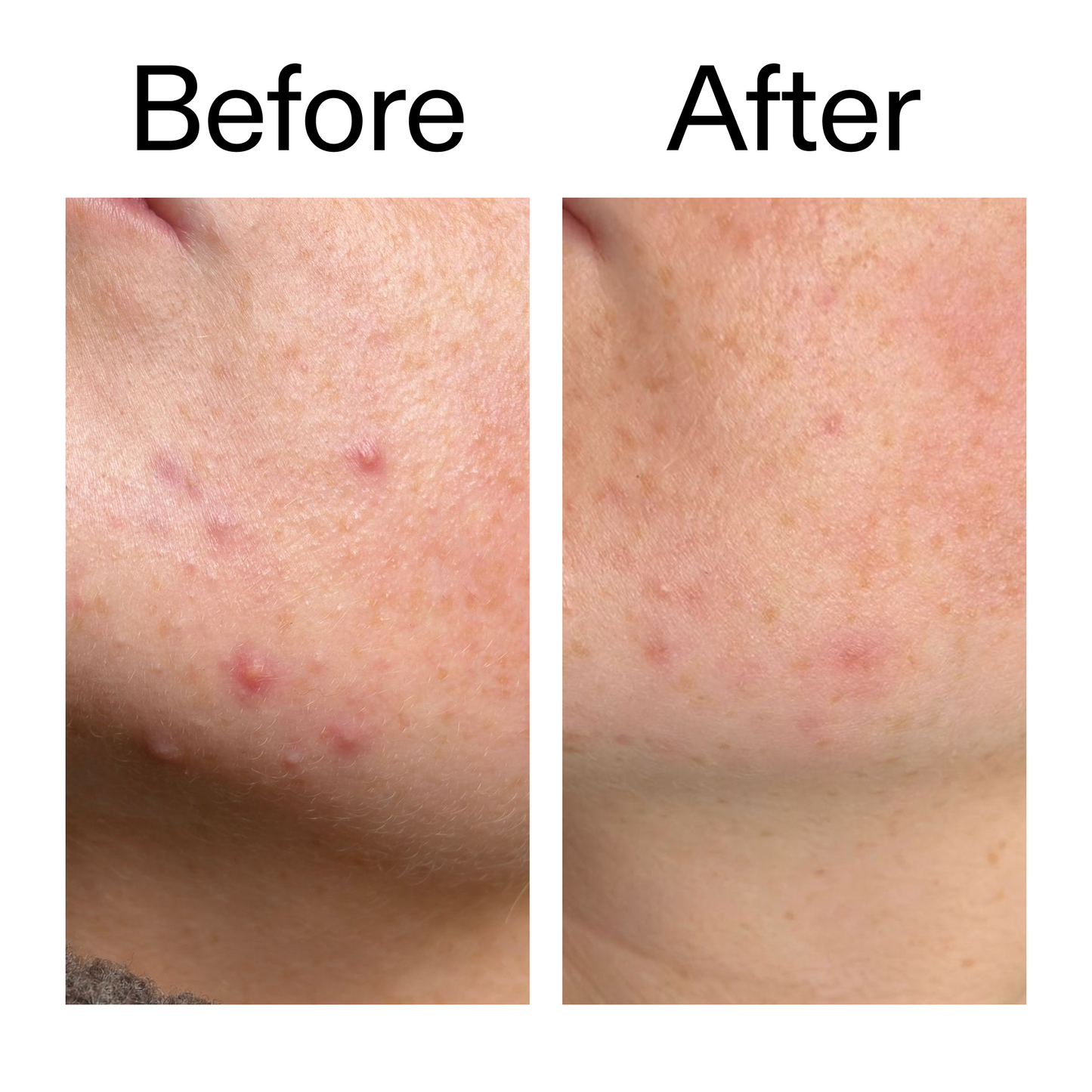 10-azelaic-acid-serum-for-redness-relief-t9 B_A_1_PPAGE.png