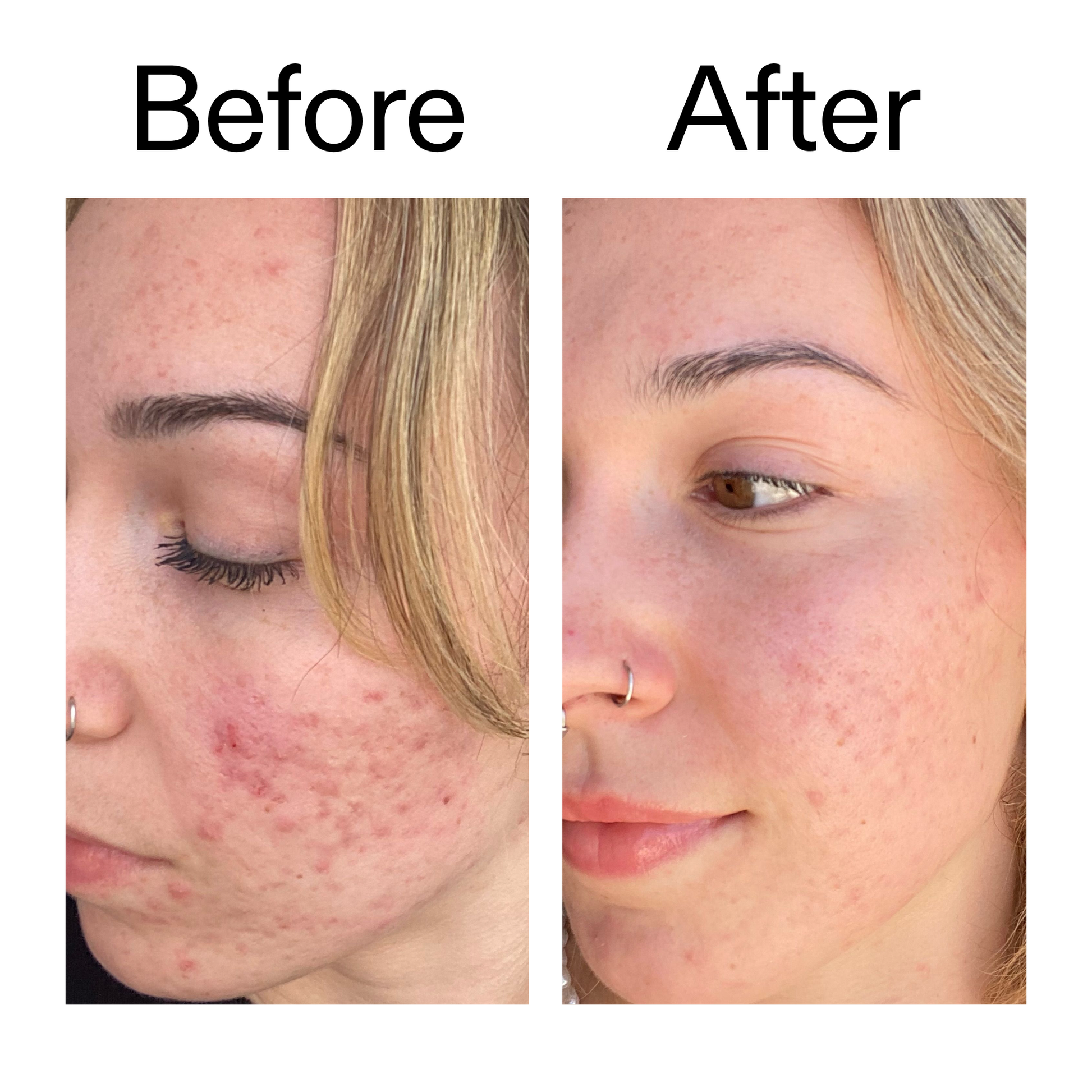 10-azelaic-acid-serum-for-redness-relief-t9 B_A_2_PPAGE.png