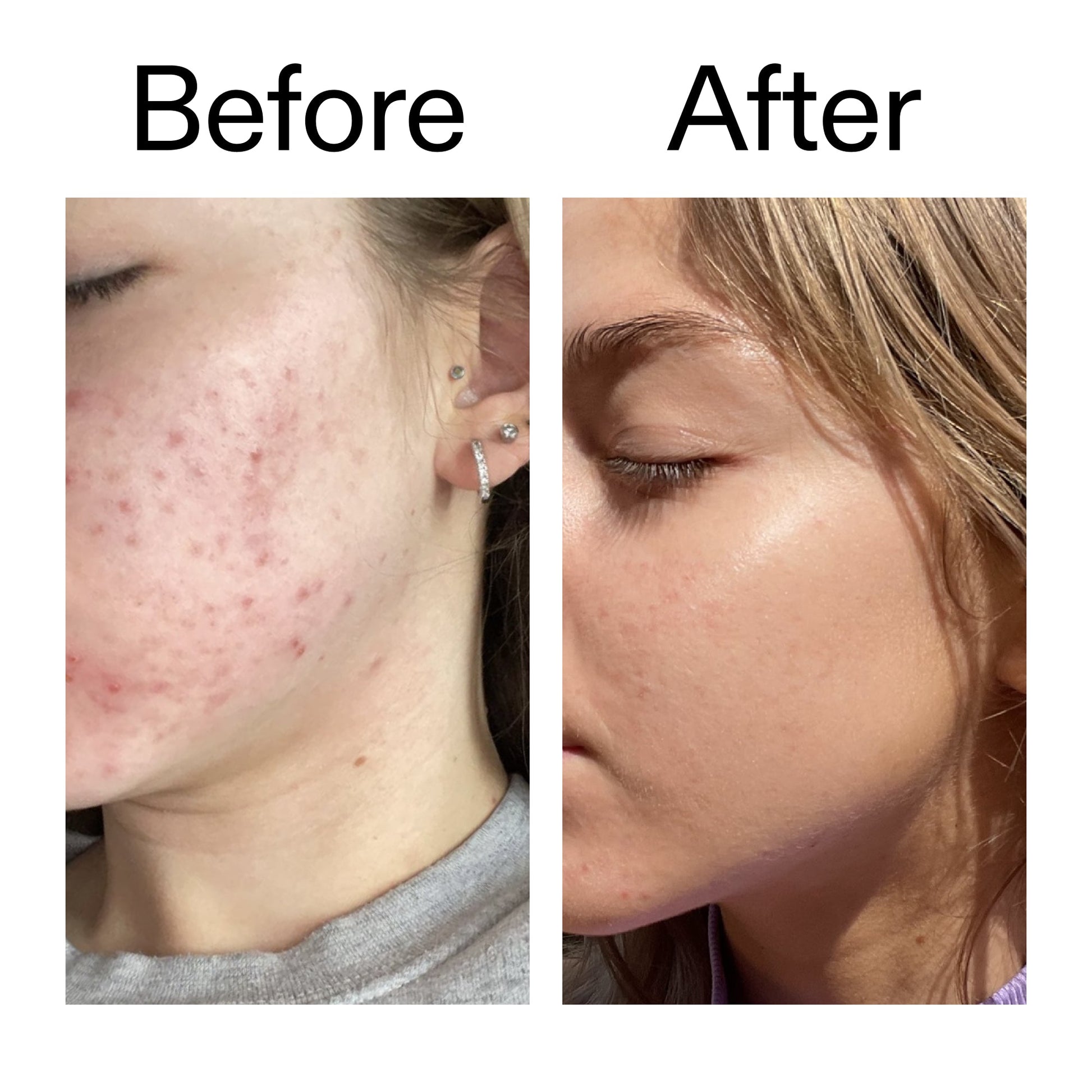 beta-hydroxy-acid-bha-serum-x6 Beta_Hydroxy_Acid_Serum_Before_After_2000x2000_96fda3e5-938d-49ef-bcf2-a0fa6ece4e2c.jpg