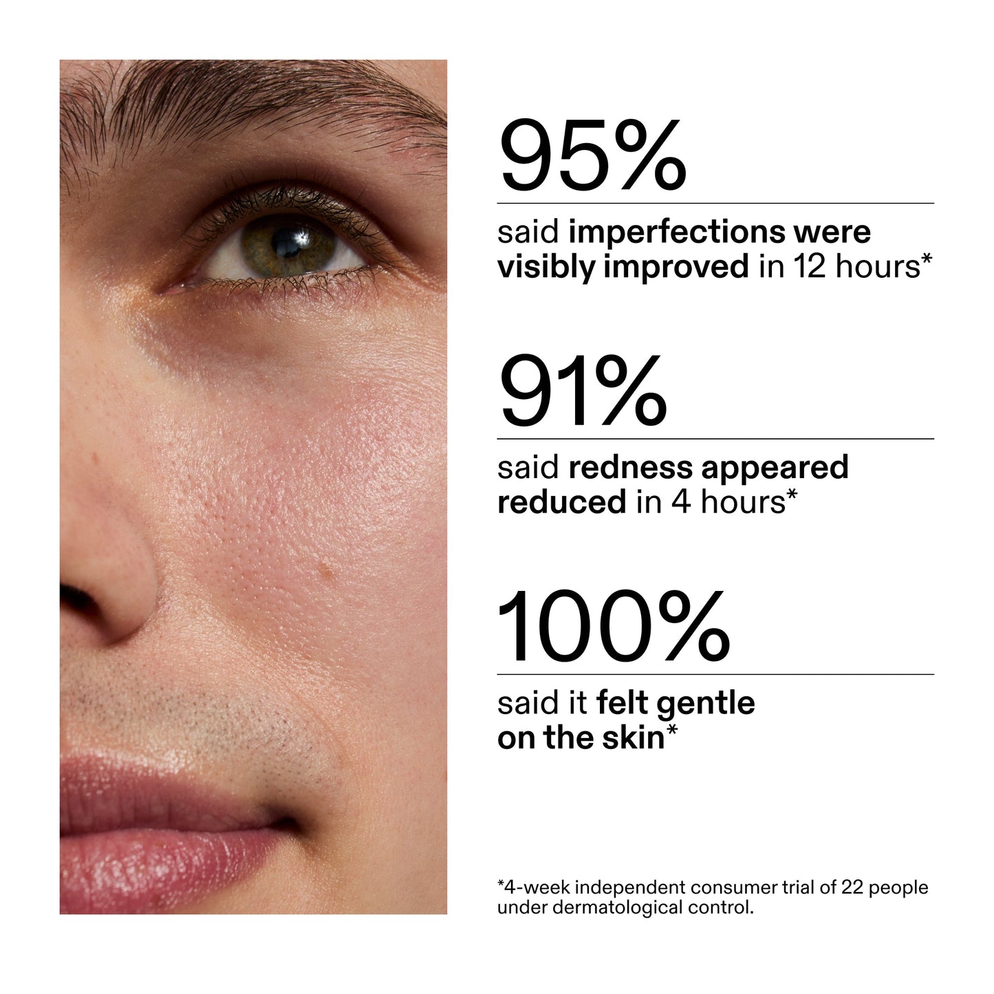 succinic-acid-acne-treatment-d3 CA_Succinic_Acid_Treatment_key_Claims_2000x2000_db91b0f1-7f29-4bfe-bb16-63a47f500960.jpg