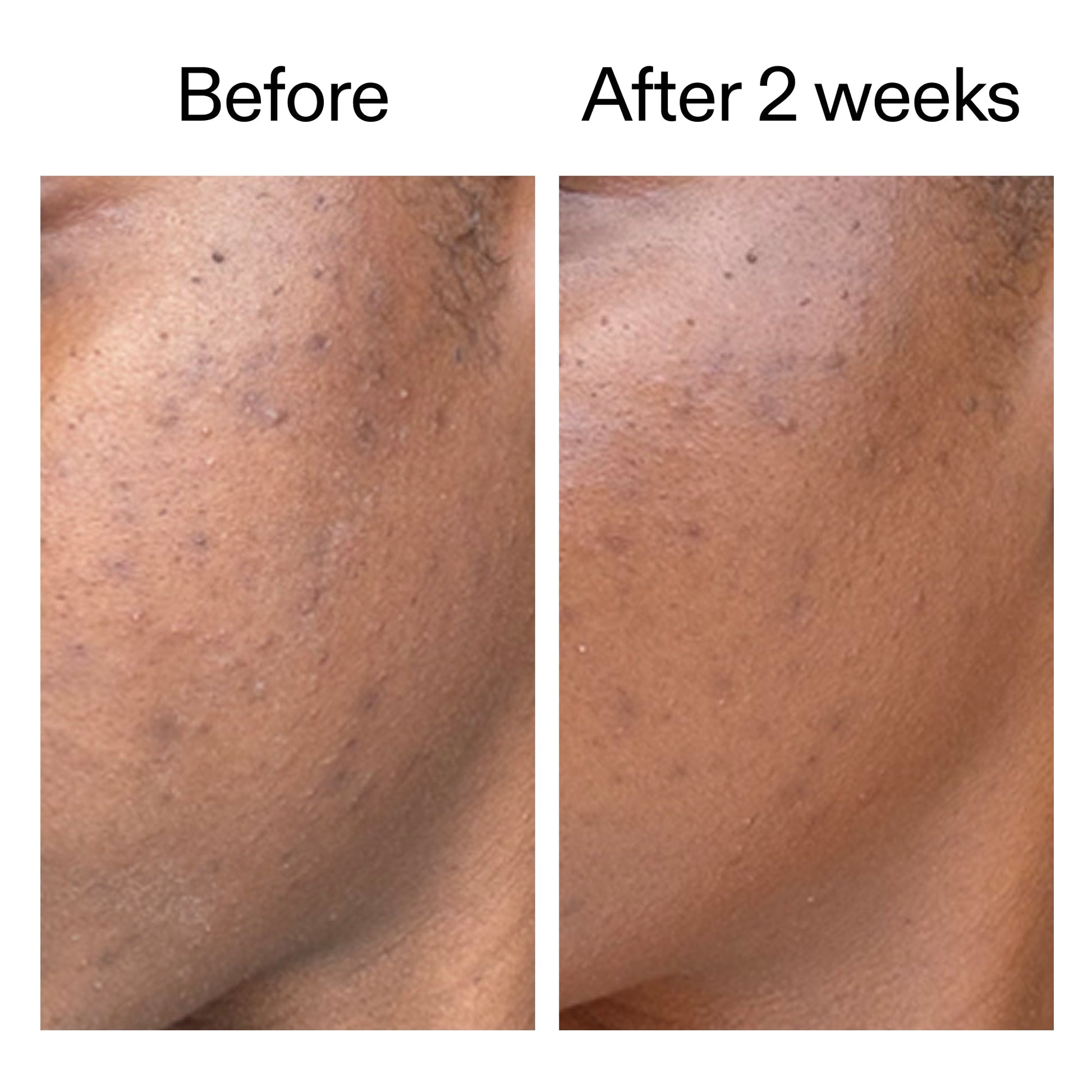 360-acne-clearing-duo-t2 DIOICB_A2000x2000.jpg