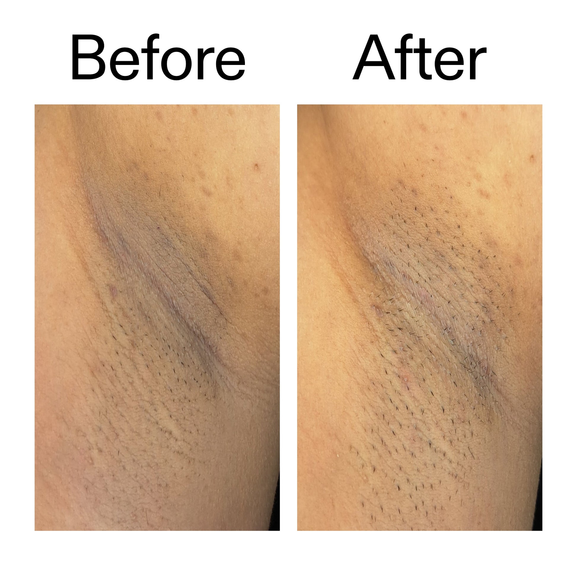 glycolic-acid-exfoliating-body-stick-u9 Glycolic_Acid_Exfoliating_Body_Stick_Before_After_V3_2000x2000_ea919cd9-1439-4a46-82a0-76200eb5bb42.jpg