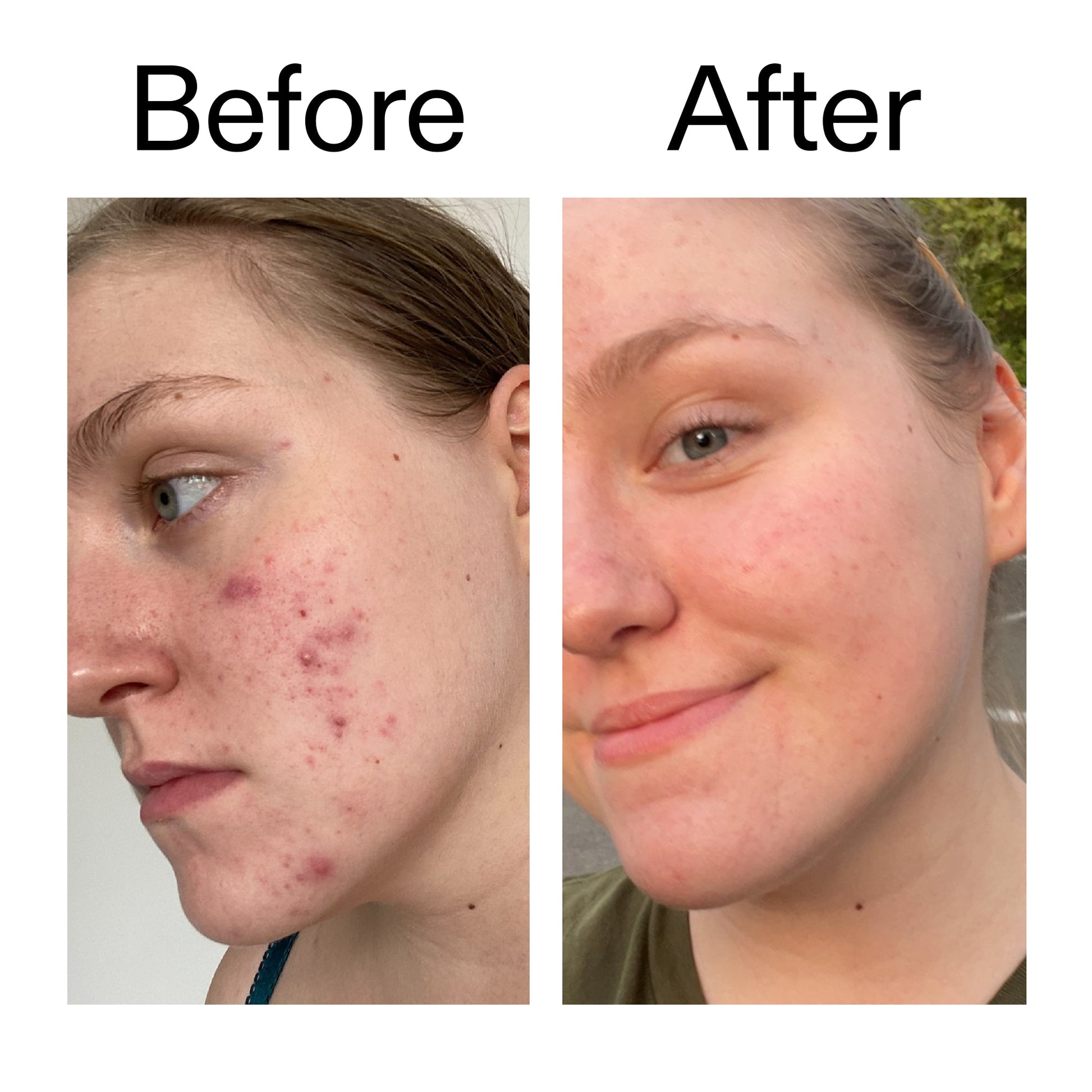 glycolic-acid-toner-s7 Glycolic_Acid_Toner_Before_After_2000x2000_49f0b9f7-e71b-4b2e-a8f8-2ea4b73247bb.jpg