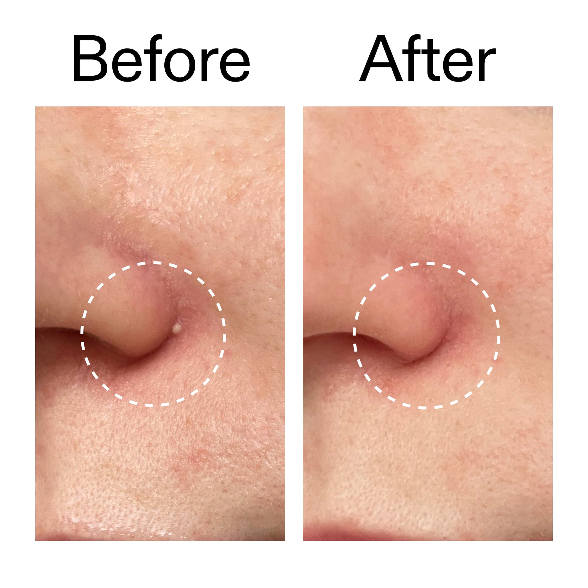 hydrocolloid-invisible-pimple-patches-pack-of-44-q8 Hydrocolloid_Invisible_Pimple_Patches_Before_After_2000x2000_b02aa37b-c78a-4682-91de-9135af5bb7df.jpg