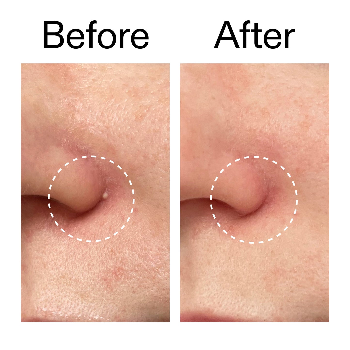 hydrocolloid-invisible-pimple-patches-pack-of-22-a0 Hydrocolloid_Invisible_Pimple_Patches_Before_After_2000x2000_b02aa37b-c78a-4682-91de-9135af5bb7df.jpg
