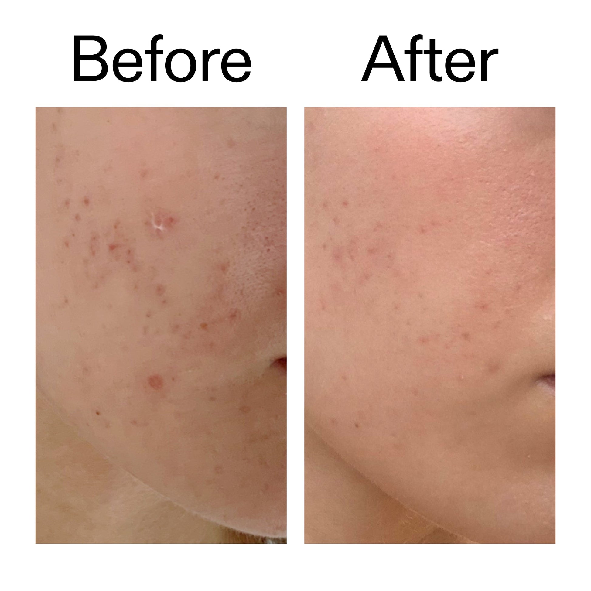 mandelic-acid-treatment-r7 Mandelic_Acid_Treatment_Before_After_2000x2000_4885ac6e-c5d7-4279-a72a-1417af7dce35.jpg