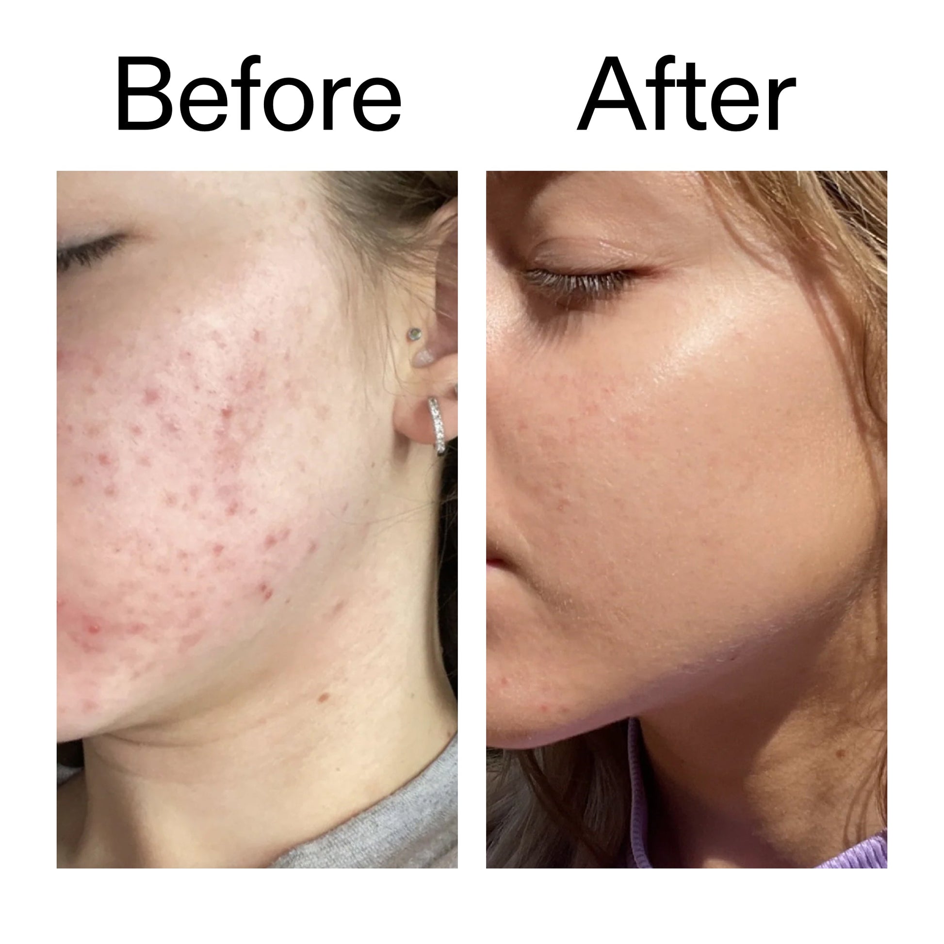 10-niacinamide-serum-n7 Niacinamide_Serum_Before_After_2000x2000_bde32455-9e7d-448e-b053-bef41504f0a9.jpg