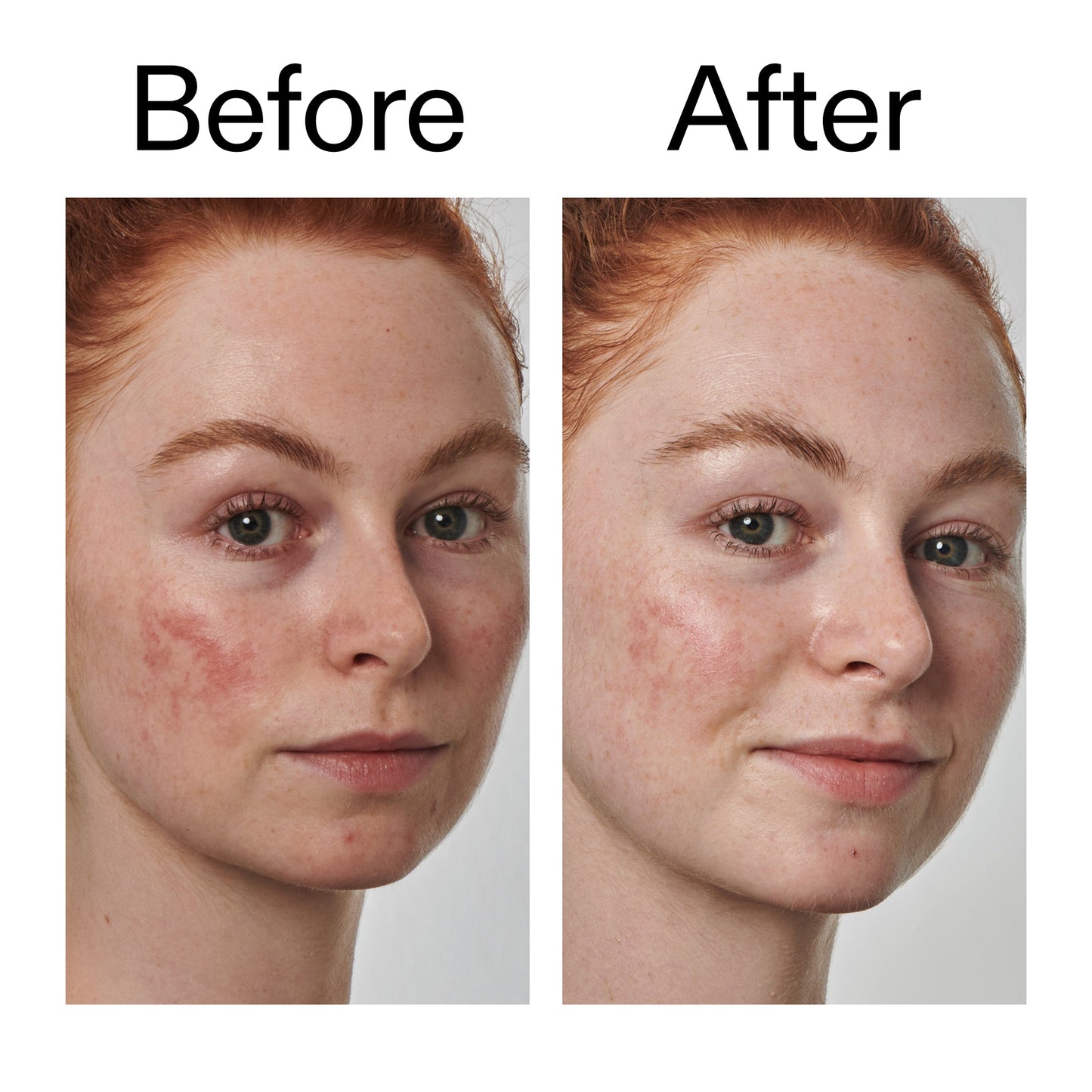 10-azelaic-acid-serum-for-redness-relief-t9 Redness_Relief_Serum_Before_After_2000x2000_3334dc9a-cce9-4e00-8aec-7ad89ca051f2.jpg