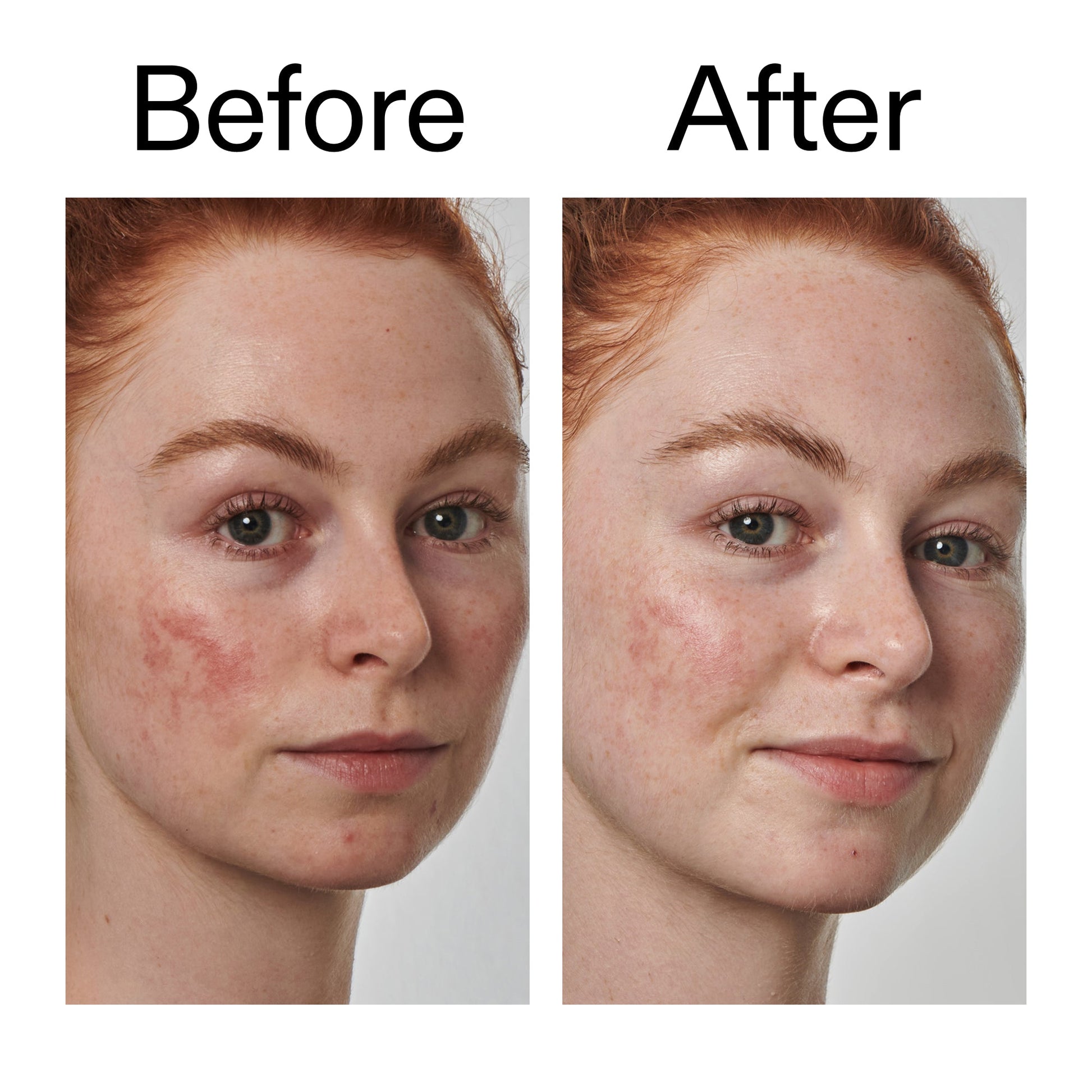 10-azelaic-acid-serum-for-redness-relief-t9 Redness_Relief_Serum_Before_After_2000x2000_3334dc9a-cce9-4e00-8aec-7ad89ca051f2.jpg