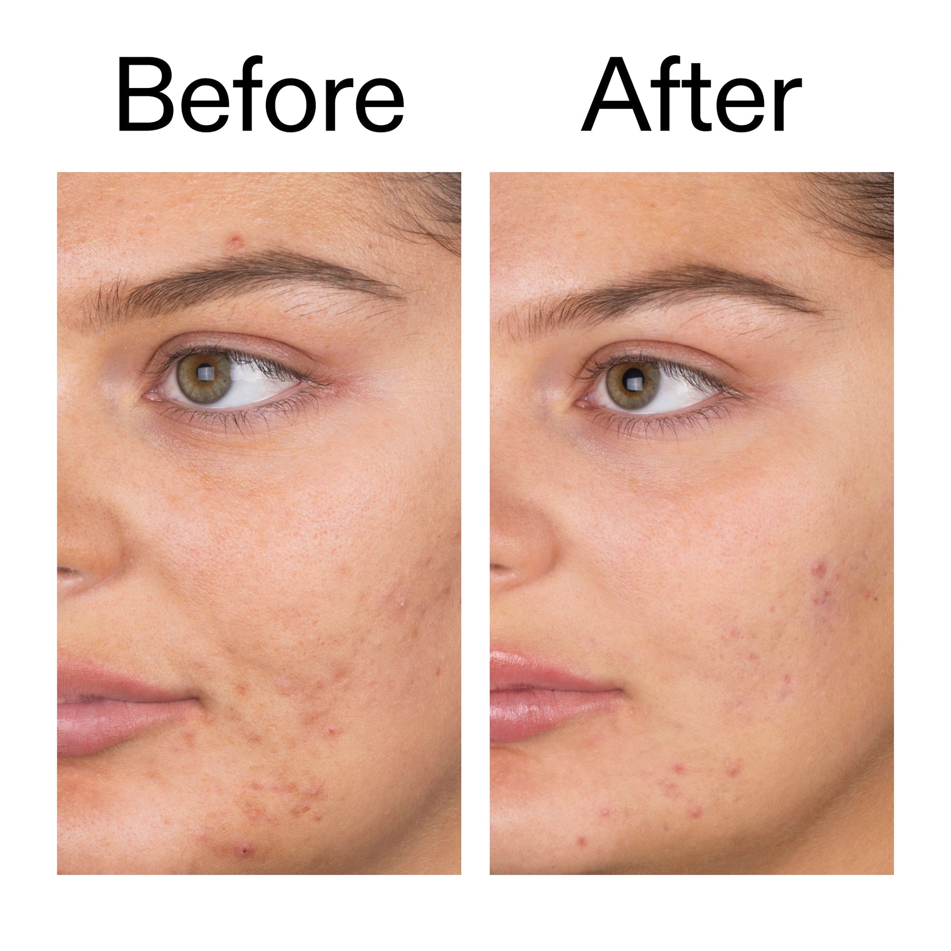 salicylic-acid-cleanser-150ml-t1 Salicylic_Acid_Cleanser_-_150ml_Before_After_2000x2000_e7230494-853f-4b07-82b1-27669104c995.jpg