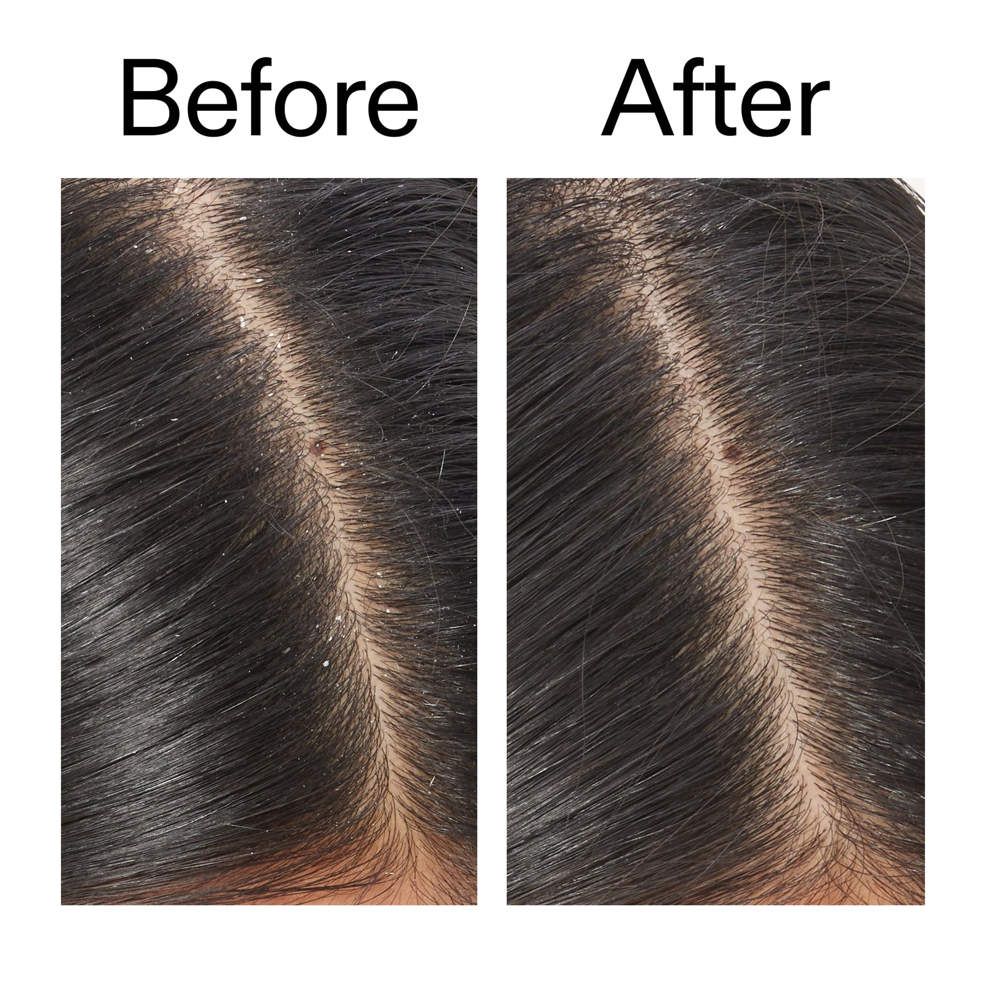 salicylic-acid-exfoliating-scalp-treatment-e5 Salicylic_Acid_Exfoliating_Scalp_Treatment_Before_After_V2_2000x2000_02bd61ad-42bf-490b-b3e3-7e04b2e8a673.jpg