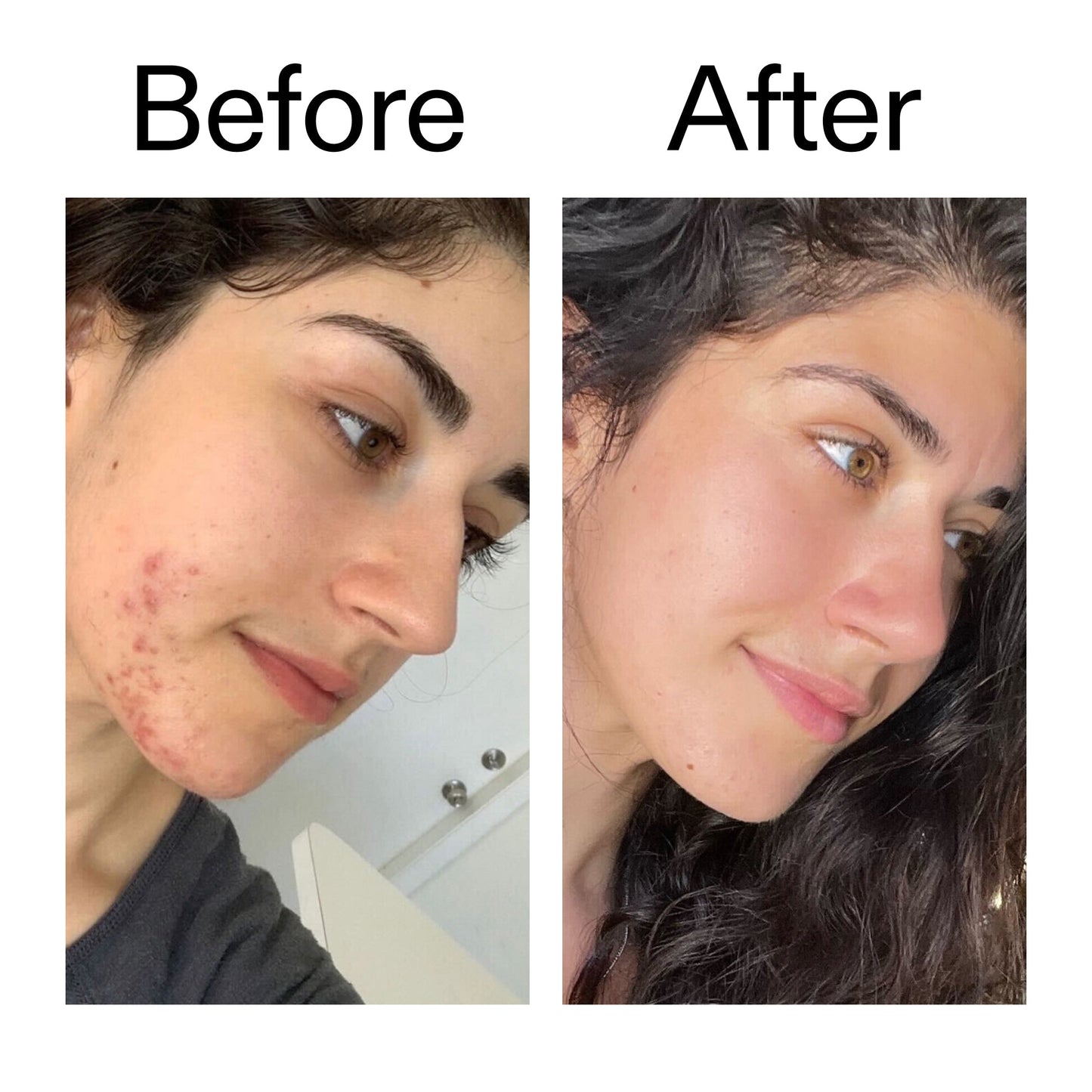 succinic-acid-acne-treatment-d3 Succinic_Acid_Treatment_Before_After_2000x2000_6a5f0054-2f58-4433-9314-0dc72c9bdd3b.jpg